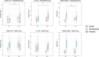Change in diaphragmatic morphology in single-lung transplant recipients: a computed tomographic study